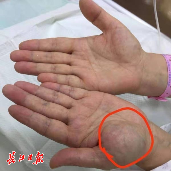 左手手掌长出的小包62岁的孙女士介绍,最近半年,她常常被手掌疼痛的