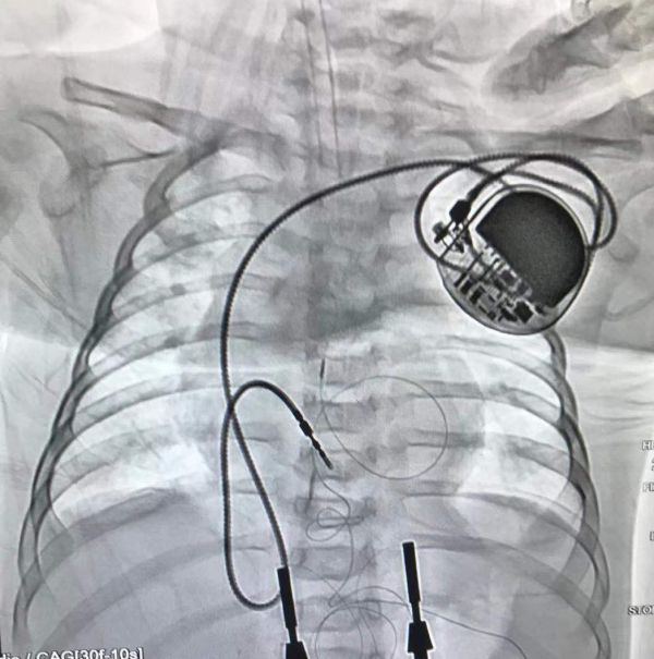 出生4月随时可能夭折医生给宝宝植入火柴盒大小的心脏起搏器