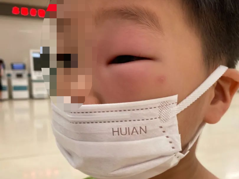 小严严的孩子被蚊子咬到看不见眼睛.